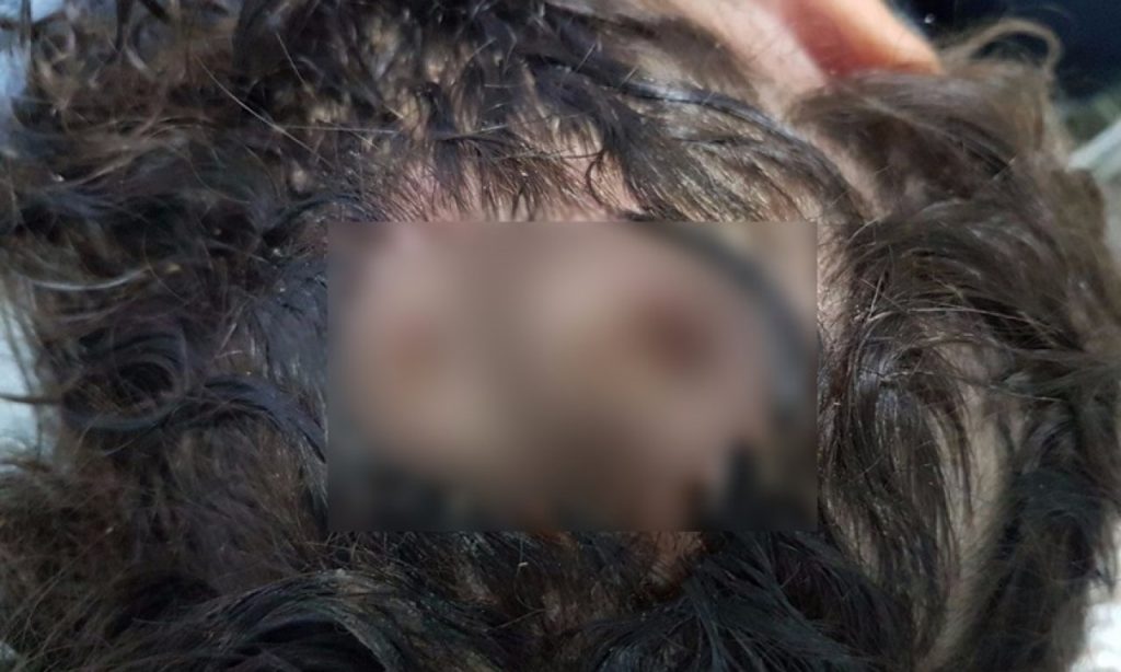 Imagem Ilustrando a Notícia: Mãe de criança internada com larvas na cabeça está sofrendo ameaças