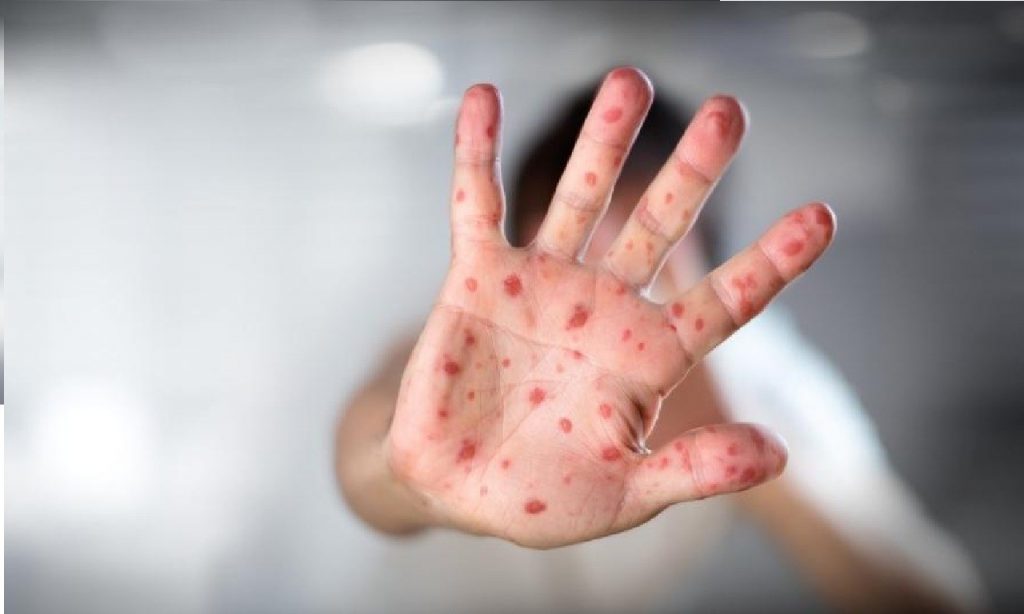Imagem Ilustrando a Notícia: A campanha de vacinação contra o  sarampo vai até dia 13 de março