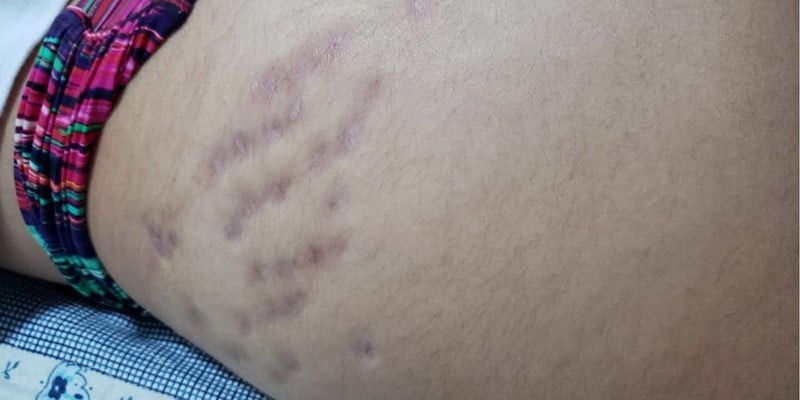 Imagem Ilustrando a Notícia: Após tratamento estético contra estrias mulheres denunciam lesões
