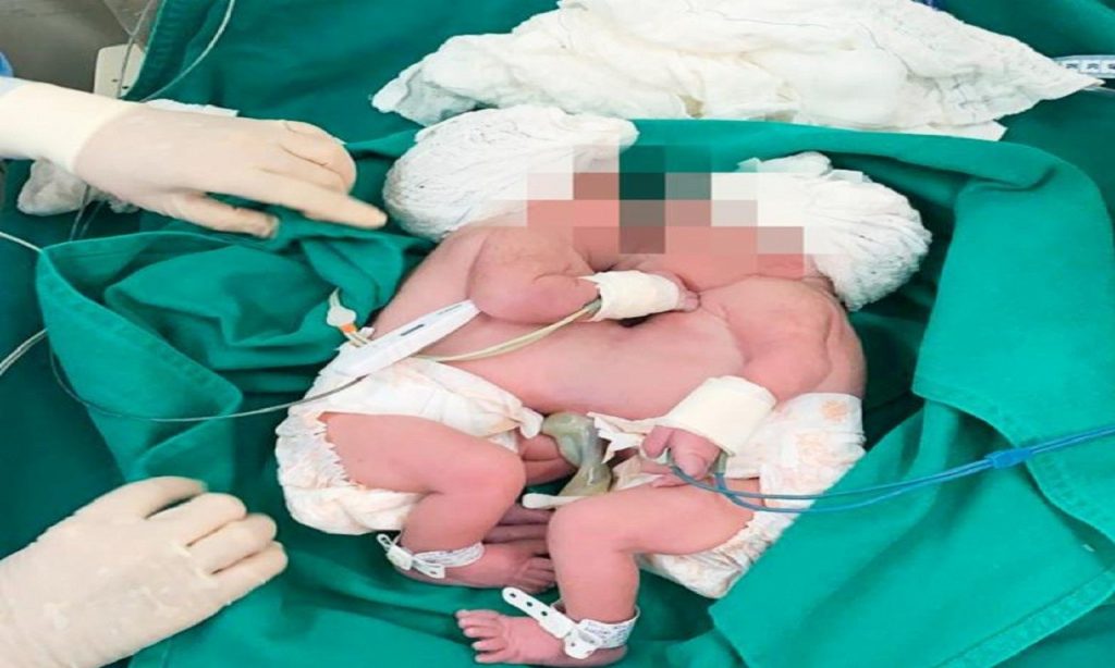 Imagem Ilustrando a Notícia: Médico goiano realizará procedimento de separação de gêmeas siamesas em Salvador