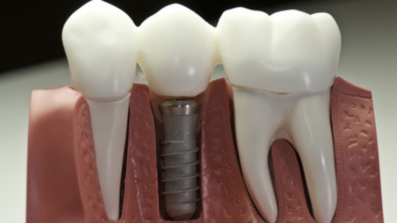 Imagem Ilustrando a Notícia: Implantes dentários falsos colocam em risco a saúde do paciente
