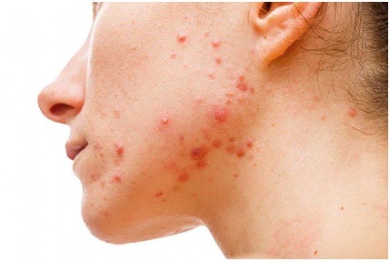 Imagem Ilustrando a Notícia: Dermatite atópica pode afetar 25% de crianças e 7% de adultos