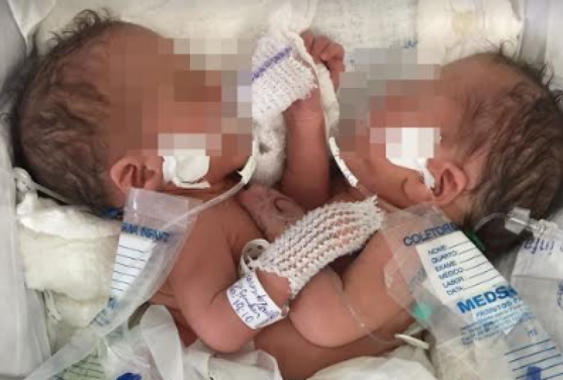 Imagem Ilustrando a Notícia: Com dois dias de vida, estado de saúde de gêmeas siamesas é regular