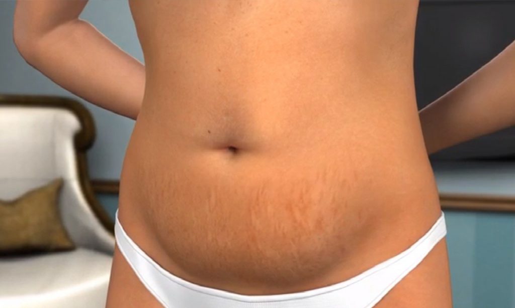 Imagem Ilustrando a Notícia: Abdominoplastia é aliada para quem perdeu peso após bariátrica