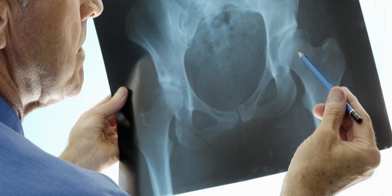 Imagem Ilustrando a Notícia: Osteoporose é uma doença que já atinge 10 milhões de brasileiros
