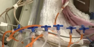 Siamesa separada da irmã na semana passada precisa de cirurgia no coração com urgência para sobreviver