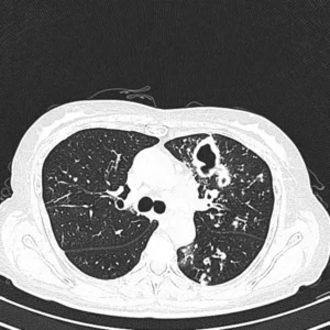 Tuberculose Pulmonar | Foto: Arquivo/Radiopaedia