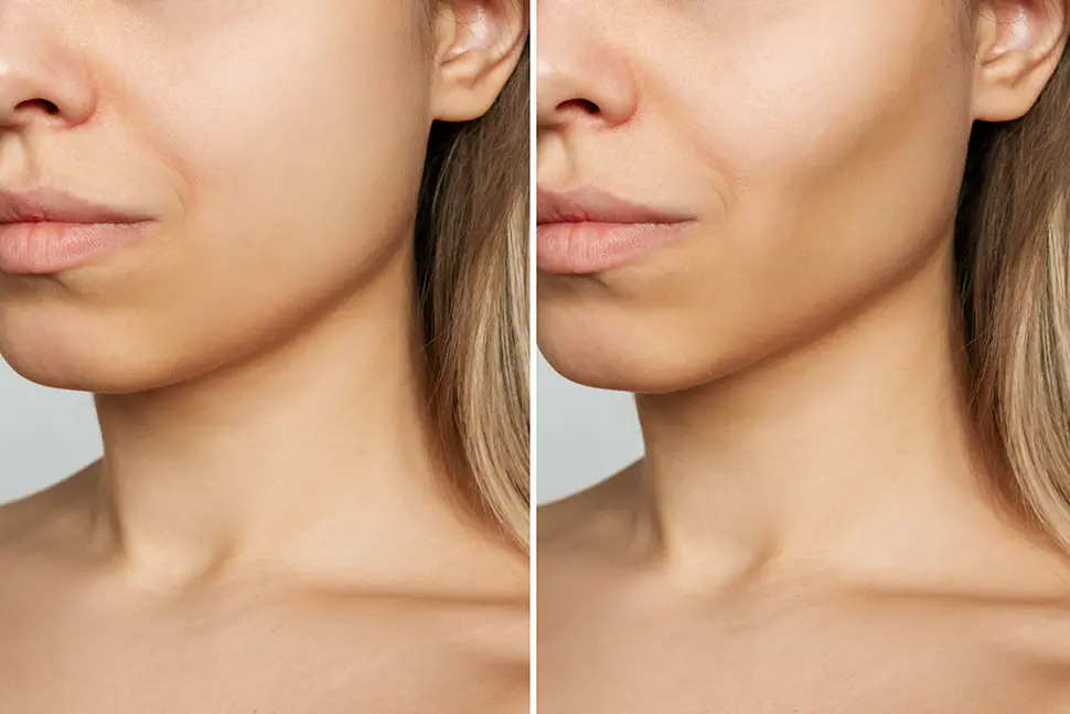 Biomédica orienta sobre as melhores opções para manter a aparência jovial mesmo após a perda de gordura de forma acelerada. | Foto: Reprodução