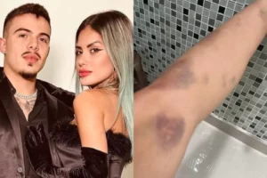 A ex-fazenda tirou fotos dos machucados e apresentou à polícia | Foto: Reprodução