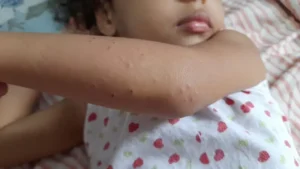 Casos da Síndrome demandam atenção dos pais aos cuidados com os filhos, já que essa é uma doença contagiosa | Foto: Divulgação/SES
