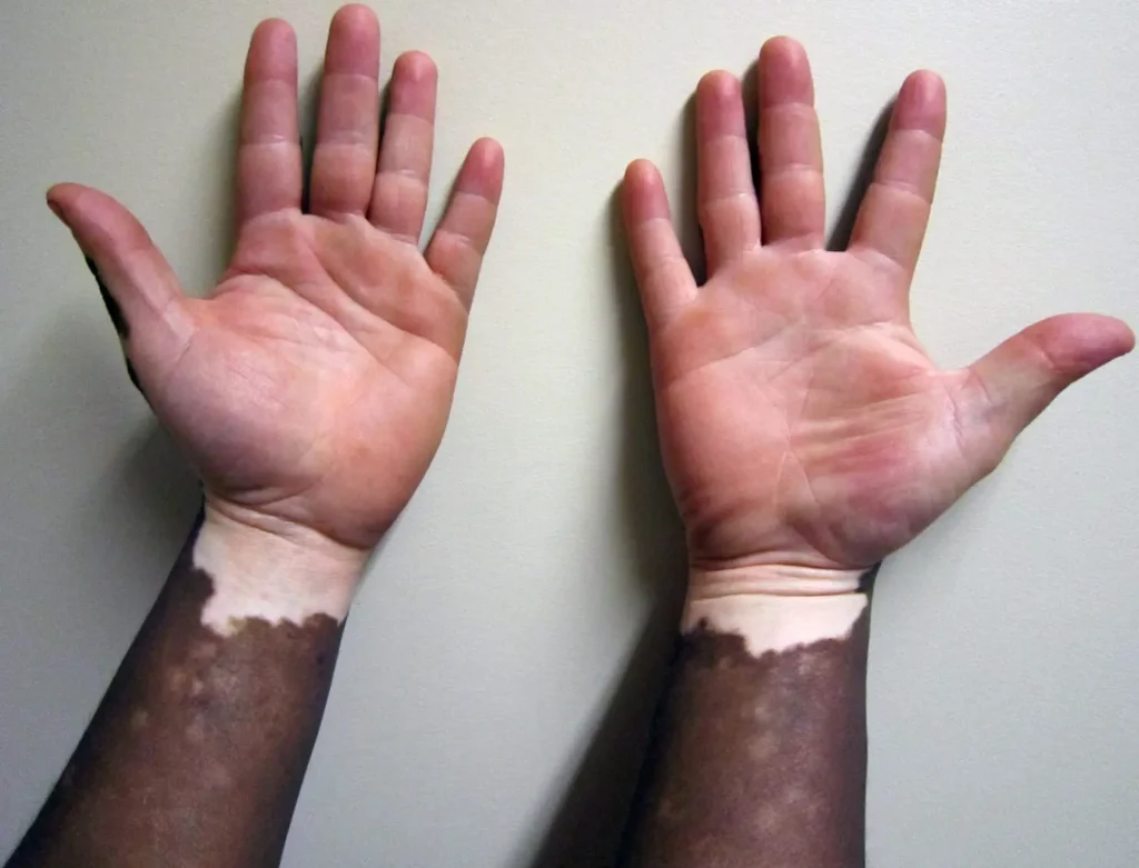 Um dos motivos que pode levar a pessoa a desenvolver o vitiligo é histórico familiar | Foto: Reprodução