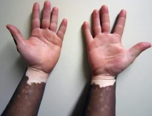 Um dos motivos que pode levar a pessoa a desenvolver o vitiligo é histórico familiar | Foto: Reprodução