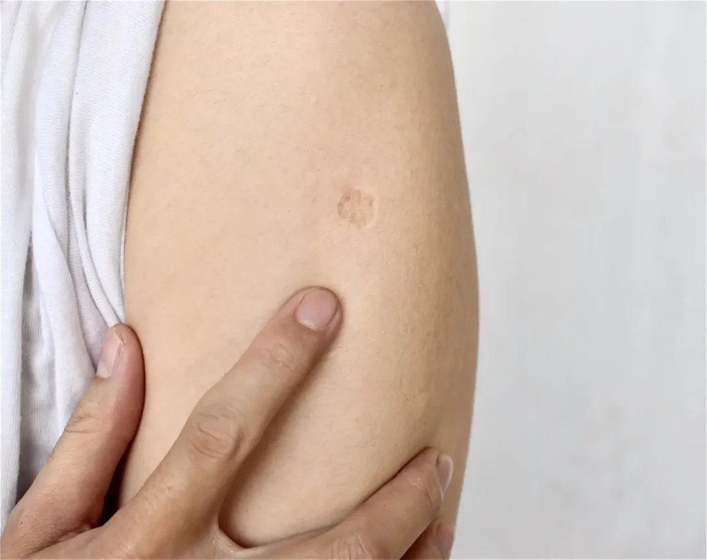 BCG or TB vaccine scar mark at the arm of Southeast Asian man.