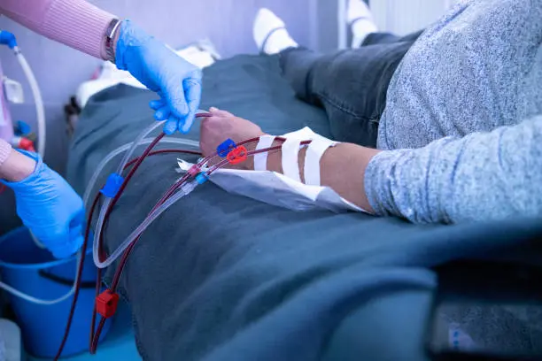 A nurse with blue protective gloves is preparing a patient for hemodialysis - healthcare and medicine concepts.