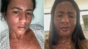 A influencer ficou 10 dias internada na UTI devido a síndrome de Stevens-Johnson | Foto: Reprodução/Instagram