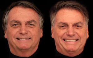 O ex-presidente passou por uma harmonização em todos os seus 28 dentes | Foto: Reprodução