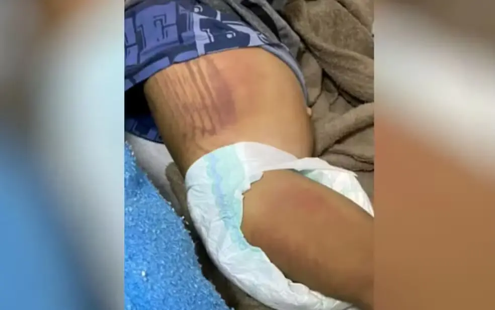 Ferimentos no corpo do menino de 1 ano e 11 meses. | Foto: Reprodução