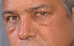 João foi picado na região do rosto, pescoço e nos braços | Foto: Reprodução