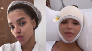 Brunna Gonçalves surgiu em suas redes sociais com a cabeça enfaixada após realizar procedimento estético de redução da testa por decorrência de avanço capilar