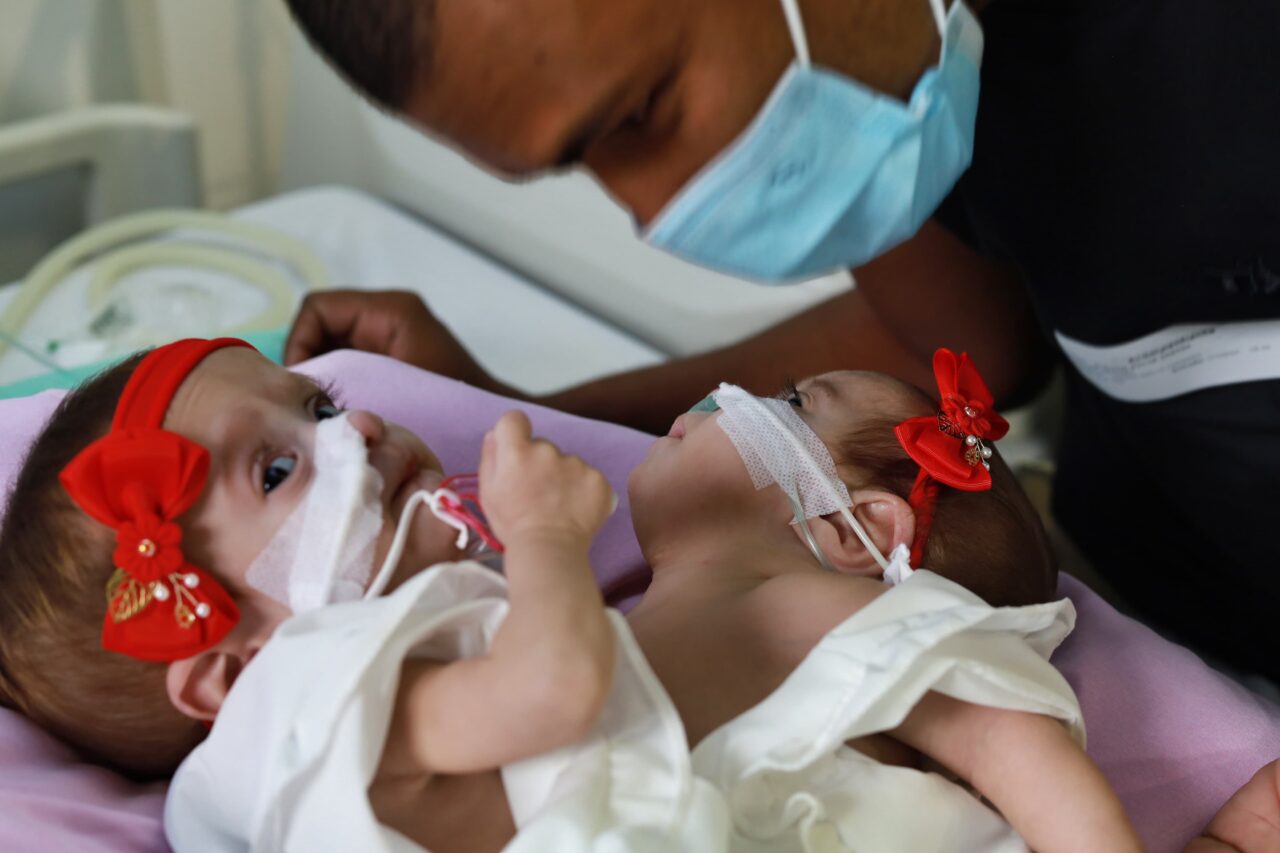 Goiás deve realizar duas cirurgias de separação de gêmeos siameses 