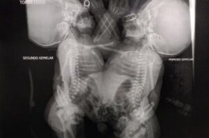 Mãe de gêmeas siamesas recebe alta; estado de saúde dos bebês é regular