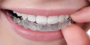 Tratamento para Bruxismo requer atenção e deve ser especializado