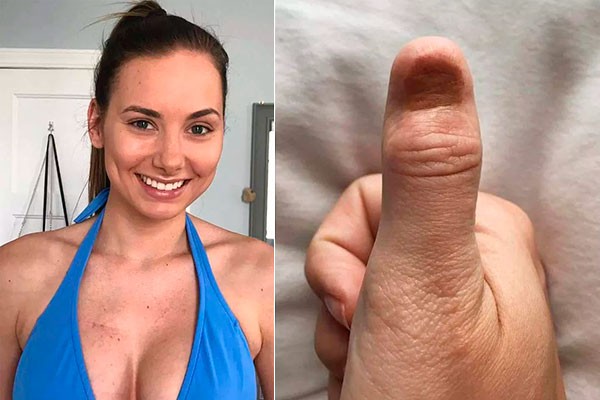 Ex-miss desenvolve câncer de pele raro devido à técnica de manicure