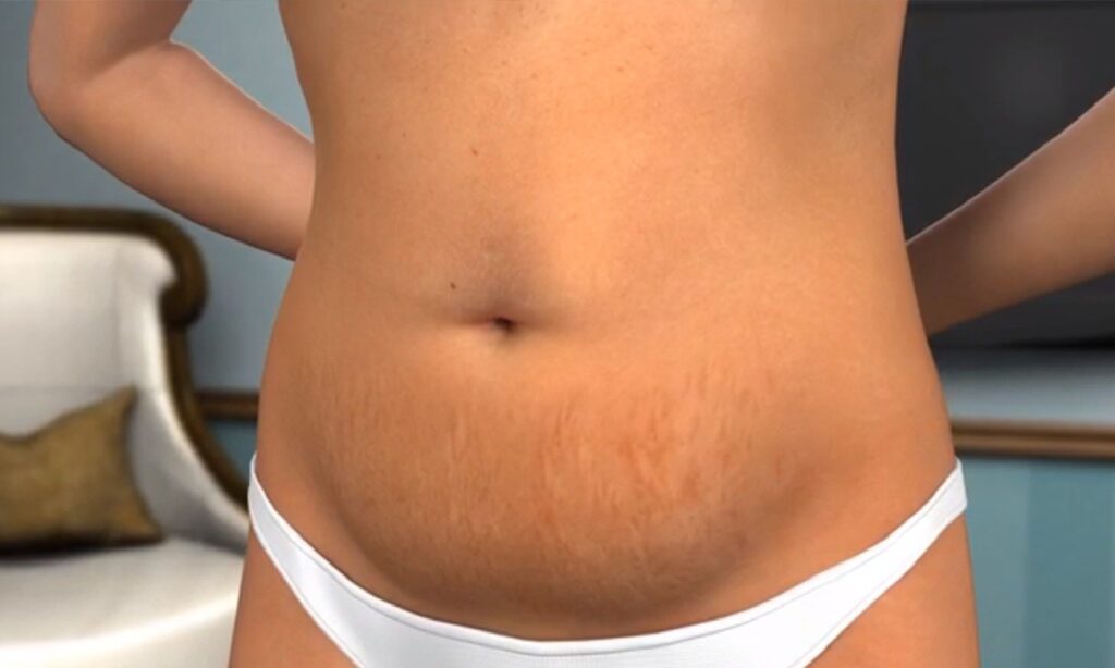 Abdominoplastia é aliada para quem perdeu peso após bariátrica