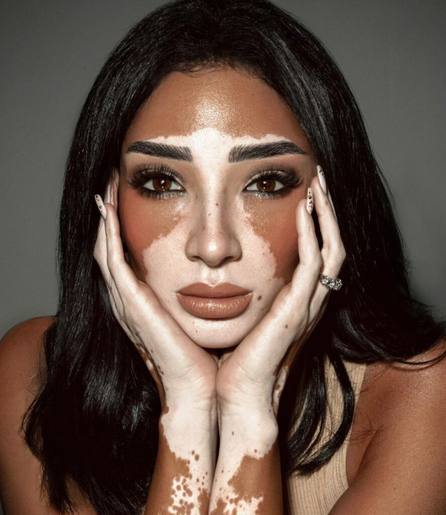 Miss Universo terá primeira candidata com vitiligo