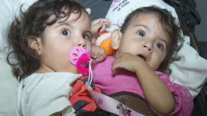 Aruna, gêmea siamesa separada da irmã Kiraz, segue em estado grave em Goiânia Foto:Reprodução - TV Anhanguera