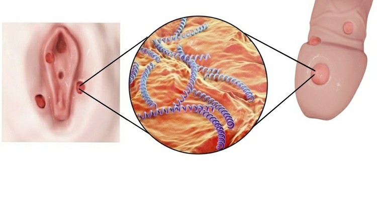 Brasil registra aumento preocupante de casos de Sífilis em homens 2 Sífilis