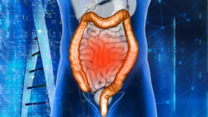 Câncer de intestino