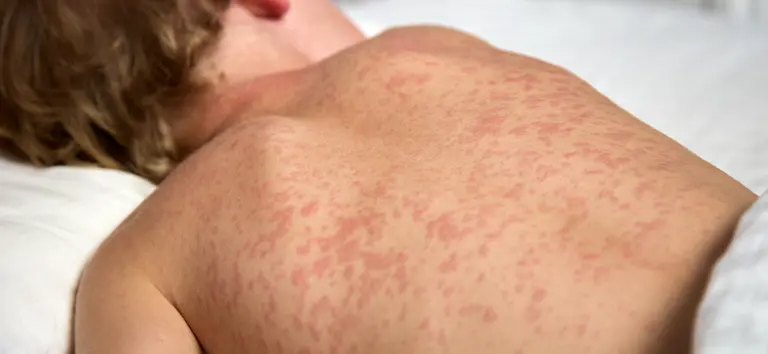 O sarampo pode evoluir de forma severa em crianças pequenas, levar à pneumonia, sequelas neurológicas e até óbito Foto: Divulgação