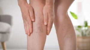 Inchaço, dor e vermelhidão nas pernas são sinais clássicos da trombose.| foto: Reprodução/canva