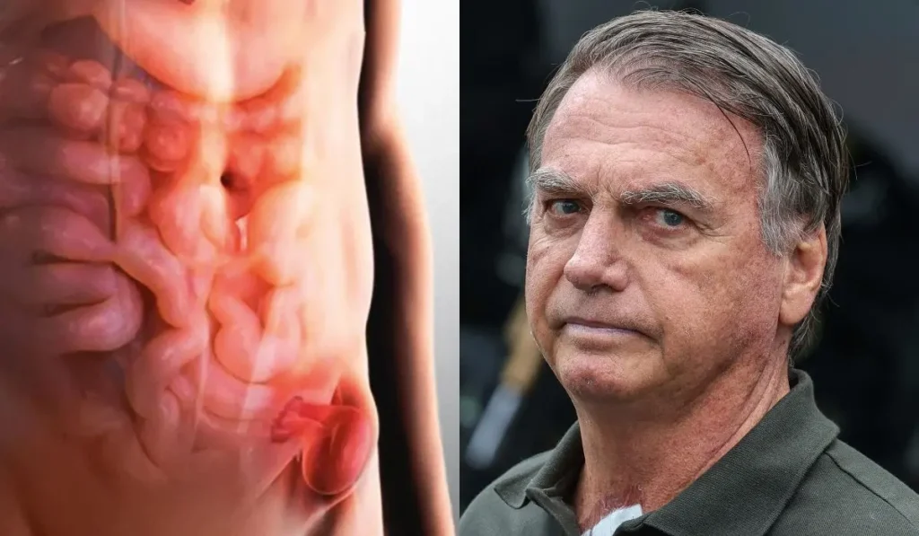 Cirurgia de Bolsonaro termina sem intercorrências e médicos detalham próximos passos 2 bolsonaro