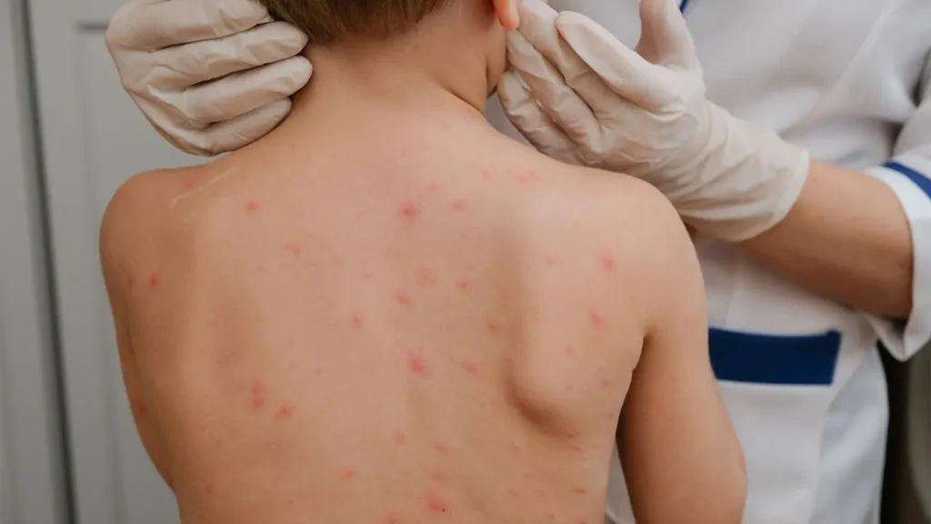 10 fecha Meningite Foto Divulgacao