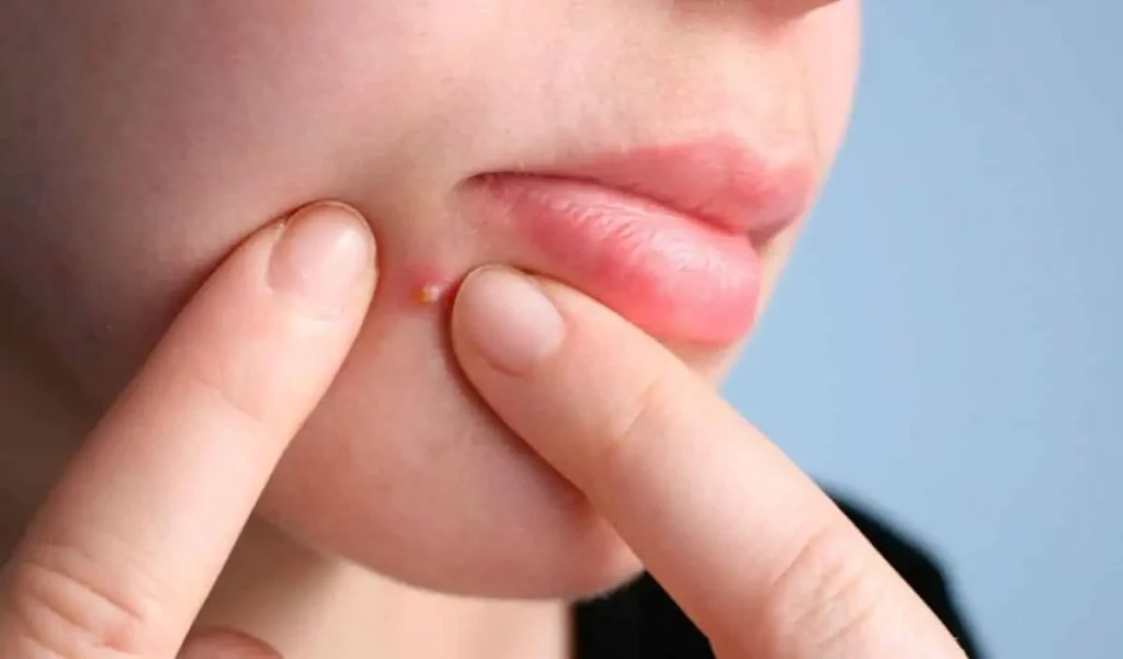 Como cuidar da pele de forma eficaz para pessoas com acne sem aumentar a irritação 2 espinha no rosto
