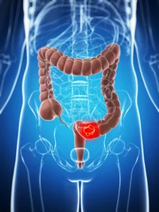 SUS anuncia novo exame para detectar câncer de intestino antes dos sintomas