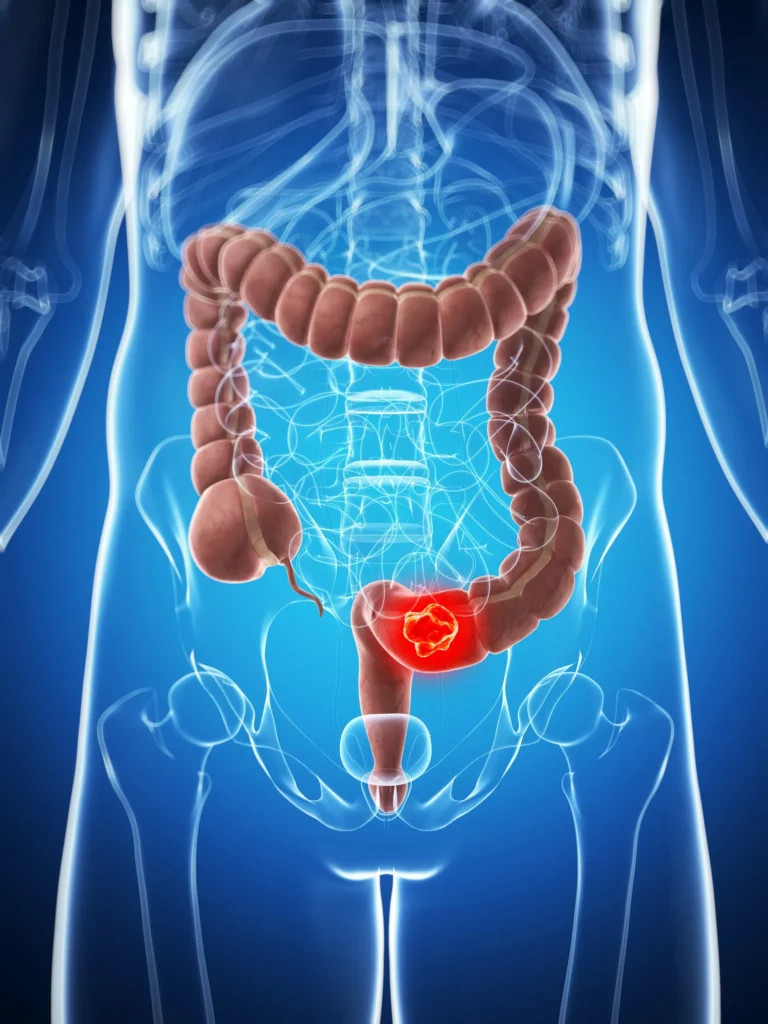 SUS anuncia novo exame para detectar câncer de intestino antes dos sintomas