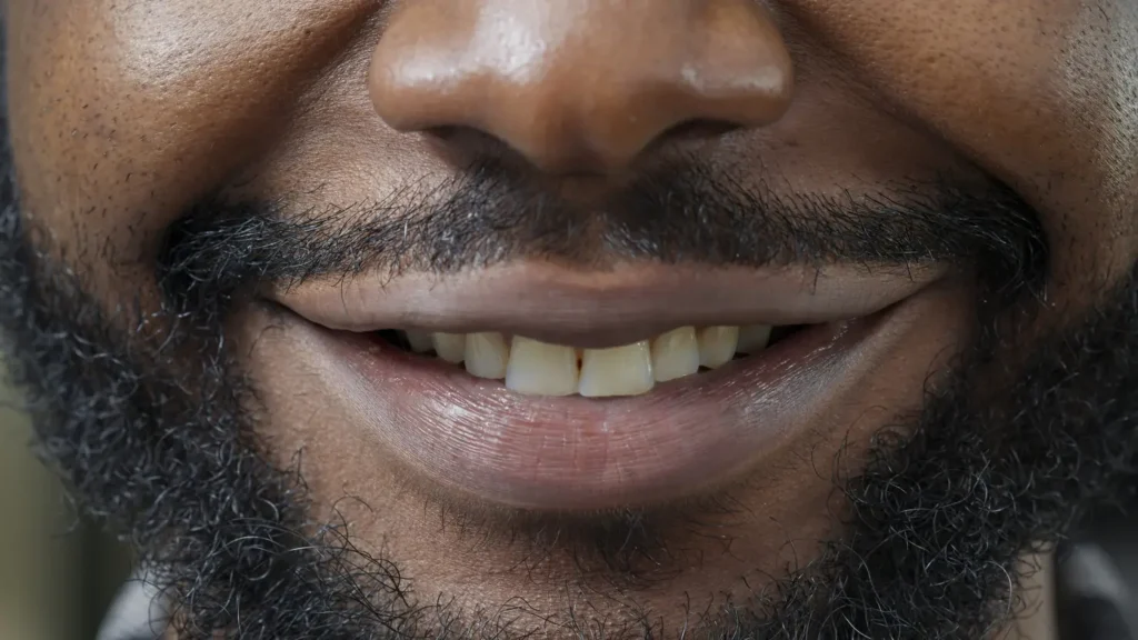 Dentes amarelados