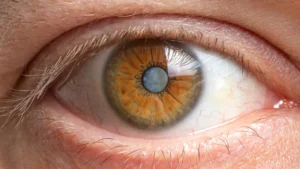 SUS incorpora cirurgia que trata catarata e glaucoma ao mesmo tempo; entenda quem pode se beneficiar