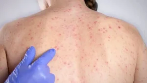 sarampo